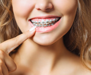 Person smiling with braces.