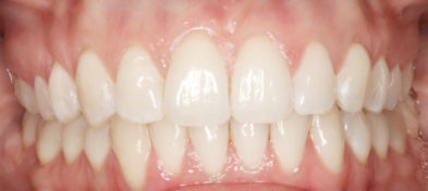 After photo of a patient's smiling teeth.