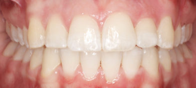 An after photo of a patient's teeth following orthodontic treatment.