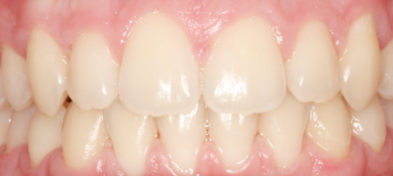 After photo of a patient's smiling teeth.