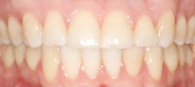 Close-up of healthy, perfectly aligned teeth after orthodontic treatment.