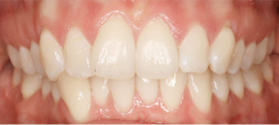 Before photo of a patient's teeth prior to orthodontic treatment.