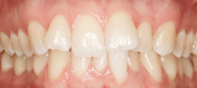 Before photo of a patient's teeth prior to orthodontic treatment.