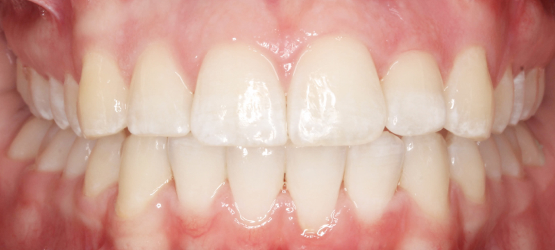 An after photo of a patient's teeth following orthodontic treatment.