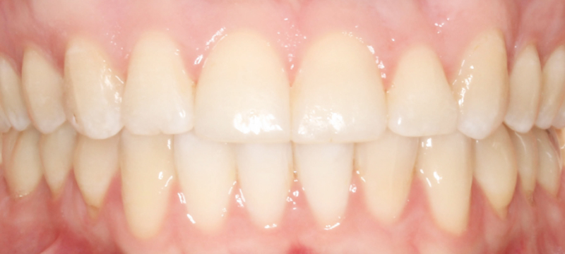 Close-up of healthy, perfectly aligned teeth after orthodontic treatment.