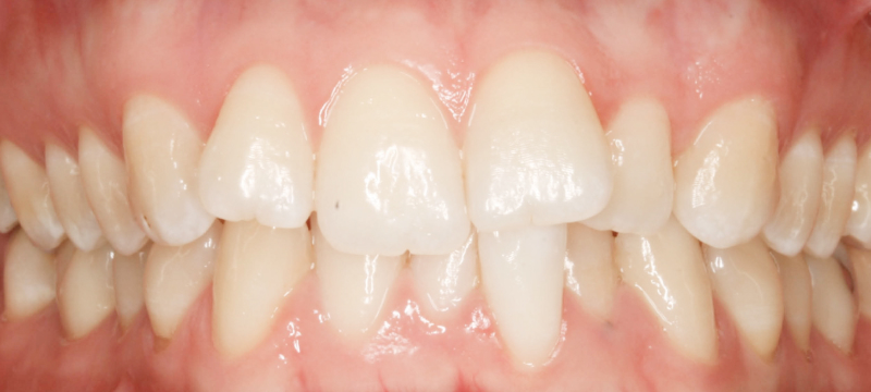 Before photo of a patient's teeth prior to orthodontic treatment.